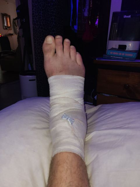 Right foot and ankle wrapped in a bandage, resting on a pillow