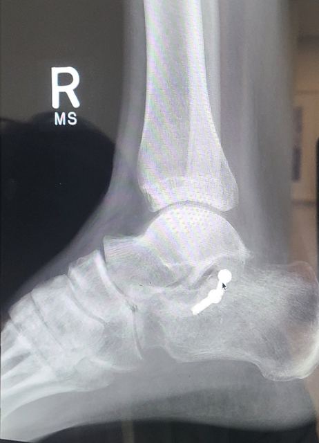Side X-ray of the right ankle and heel with two surgical screws through the heel bone
