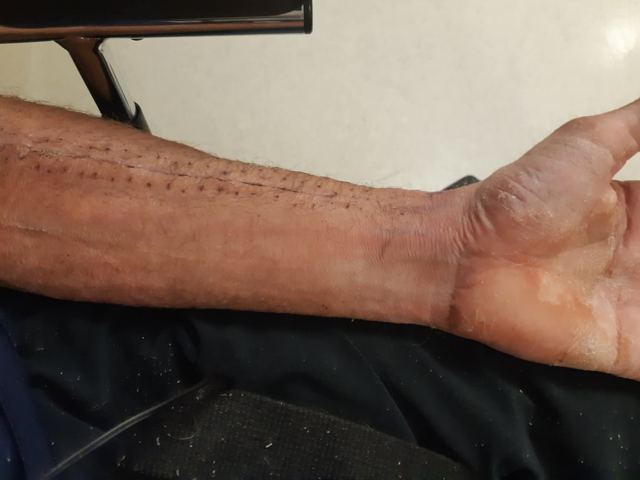 Forearm and wrist with a long healed surgical scar